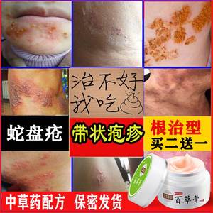 带状泡疹膏蛇胆疮蛇缠腰龙后遗症神经刺痛丹佰疱清奇方拔毒祛痛膏