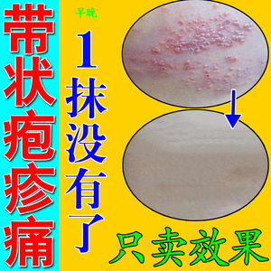 蛇盘疮带状疱疹后遗症神经痛外用药膏喷剂蛇缠腰断疼痛根克星中药