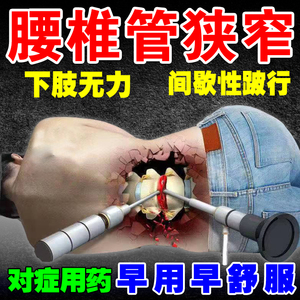 腰椎管狭窄腰间盘突出专用治压迫神经腰疼屁股疼麻下肢无力的药膏