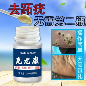 治疗去鸡眼药膏跖疣寻常疣瘊专用膏去根去除足部神器净去除膏的药