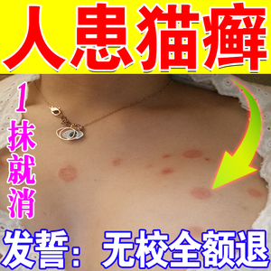 止痒不留疤】猫癣专用药人用人得猫癣药膏皮肤红肿瘙痒圆癣金钱癣