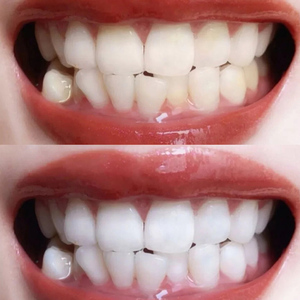 美白牙齿牙贴去黄