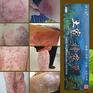 烂手药膏湿症药膏 外用铜钱癣药膏皮囊炎药膏皮炎净外用