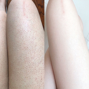 去除鸡皮肤疙瘩毛囊角化维a酸软膏鱼鳞毛周腿部手臂红黑点治克星