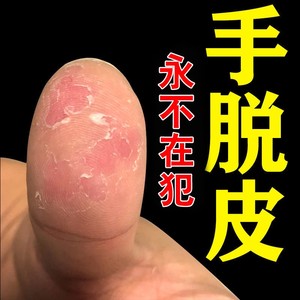 手脱皮药膏季节性手脚湿疹干燥开裂抑菌汗疱足疹止痒修复鹅掌枫风