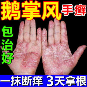 鹅掌风治手裂的药膏真菌感染手干裂脱皮手上小水泡手足癣去根神器