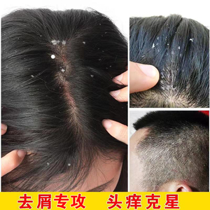 去屑止痒洗发水医药正品治头皮屑严重的药去螨虫头痒抗真菌女控油