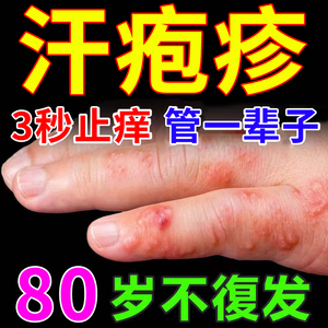 日本湿疹汗疱疹皮肤专用治疗手上起小水泡无激素止痒去根专用药膏