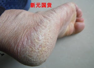 tb037075747728淘宝手指头脱白皮脚气百霸肤霸药膏草本抑菌乳膏皮肤