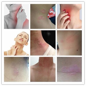 脖子痒红刺挠外用抑菌止痒皮肤上有皮藓长癣身上瘙痒长疹子起疙瘩