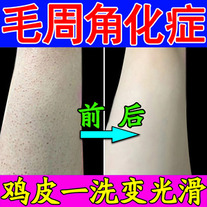 毛周角化症去鸡皮肤疙瘩沐浴露脸汗毛孔堵塞疏通炎毛囊儿童修复霜