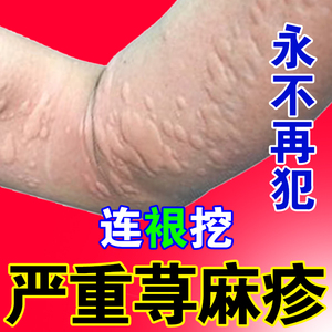 荨麻疹过敏止痒根断专用药膏治疗急慢性风团湿疹成人儿童皮肤瘙痒