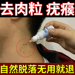 祛肉瘤皮赘去除膏去猴子脖子上长的小肉粒痣疙瘩凸痣肉刺丝状疣药