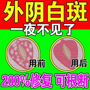 外阴白斑萎缩营养不良苔藓肛周不适瘙痒治疗外阴白斑的药膏止痒膏
