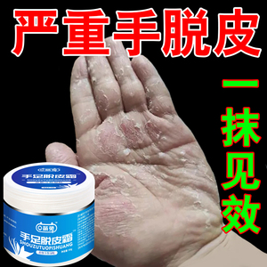 冬天手脱皮儿童药膏真菌感染季节性粗糙干燥瘙痒严重护手止痒药膏