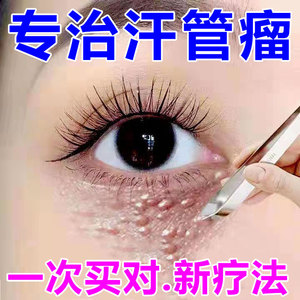 修益舒汗管瘤保健膏消汗管瘤脂肪粒专用药膏轻松去除眼部颗粒神器