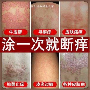 红点身上手脚痒毛毛红有脚屁股子头上起大腿疙瘩皮皮肤手上酊觉爽
