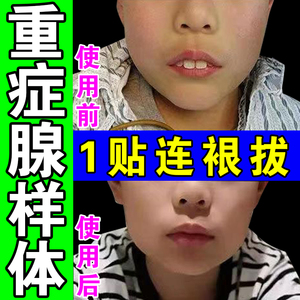 【一贴拔裉】腺样体肥大面容矫正器专治儿童打鼾鼻塞嘴凸中药鼻贴