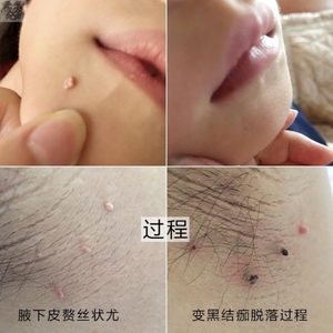 除疣软疣传染性成人儿童小孩水瘊子病毒性软疣扁平尤可去除丝状疣