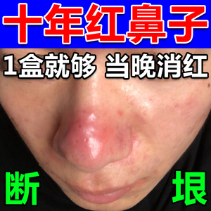 治酒糟鼻红鼻子专用药鼻头红肿鼻翼两侧红毛孔粗大修复软膏去黑头