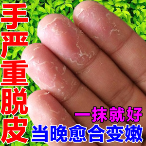 手脱皮药膏季节性手脱皮起水泡干裂干燥瘙痒抑菌止痒膏鹅掌凤