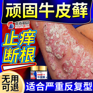 牛皮癣股藓过敏湿疹止痒根去皮肤专用特效正品杀菌药膏银屑病治