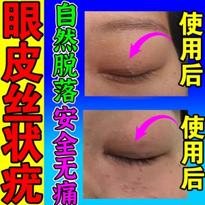 丝状疣眼皮刺猴去除正品治瘊子肉粒疙瘩去皮赘小肉揪鸦胆子祛疣膏