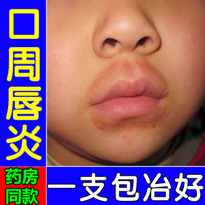 孕妇儿童嘴唇干裂唇炎润唇膏嘴巴干裂脱皮烂嘴角唇周炎保湿专用药
