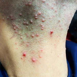 火疖子拔毒拔脓膏痤疮斑秃脱发毛囊炎膏大疖子痘痘疙瘩硬块吸脓贴