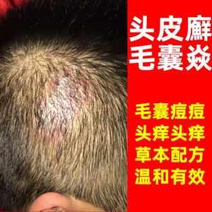 治疗毛囊炎专用药膏头皮痒克星去头癣瘙痒真菌正品头屑癣止痒草本
