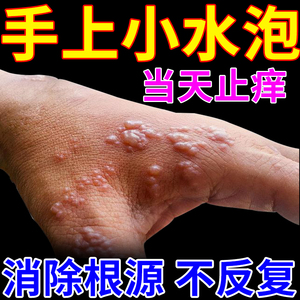 流恋絮语淘宝鹅掌风手痒干裂脱皮真菌感染汗状汗泡疱疹专用软膏治