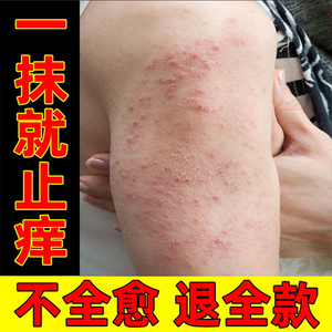 醋酸去炎松尿素软膏