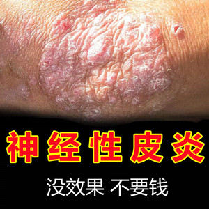 李一氏治疗神经性皮炎去根除外用膏脂溢性全身湿疹止痒顽固慢性