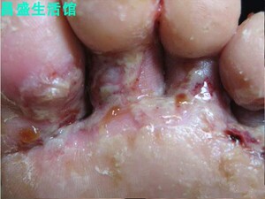 脚底板发白脚气顽达康一抹灵抑菌药膏泓宇一抹灵20g草本软膏藓 买