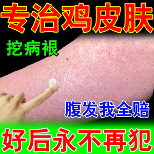毛周角化症脸毛孔堵塞疏通毛囊角化鸡皮肤疙瘩药膏儿童身体乳脸部