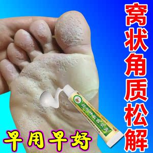 窝状角质松解症脚底蜂窝状沙虫脚糜烂型脚气出汗止汗抑菌止痒膏药