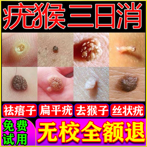 00扁平疣去除膏男克星丝状疣寻常疣面部脖子专用治疗尖锐湿疣药膏净
