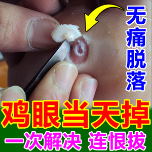 鸡眼贴足部