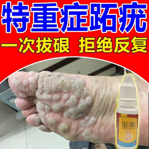 跖疣专用药膏去除足部趾疣病毒疣脚底除刺石猴子根瘊子贴特效克星