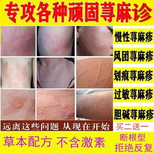 寻荨麻疹过敏止痒断根喷雾治疗风团日光性慢外用皮肤瘙痒专用药膏