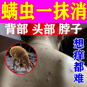 螨虫一秒消止痒药膏人用全身丘疹虫咬长痘疥疮防交叉过敏感染喷雾