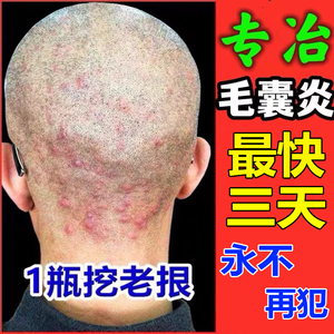 治疗头皮毛囊炎神器全身背手臂痘痘膏去鸡皮肤疙瘩毛囊堵塞角质药