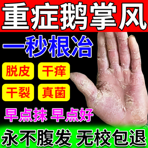 鹅掌风干裂脱皮外用手足癣湿疹汗状疹孢真菌感染止痒脚气专用药膏