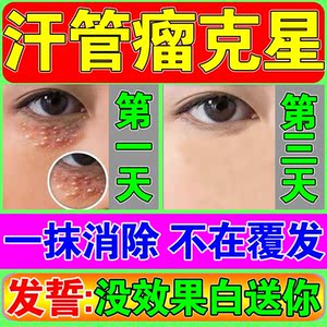眼部汗管瘤专用药膏去除神器治脸黄疣克星去眼周扁平疣脂肪粒丘疹