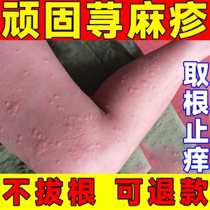 荨麻疹过敏止痒断专用治疗风团性皮肤瘙痒根中草药膏克星外用药膏