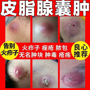 治皮脂腺囊肿膏去除粉瘤囊肿神器拔毒治疗火疖子拔毒膏囊肿痤疮