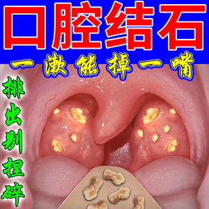 扁桃体结石漱口水牙垢结石溶解去除速效杀抗菌消除炎口臭持久留香