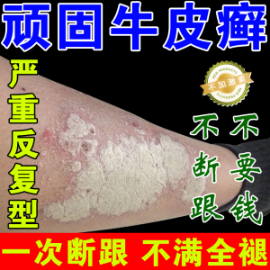 牛皮癣藓银屑病皮肤过敏湿疹手足癣头癣股体藓顽固性止痒专用药膏