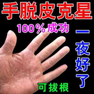 治疗手脱皮的药膏真菌感染脚干裂蜕皮护手霜手藓鹅掌风药汗疱疹药