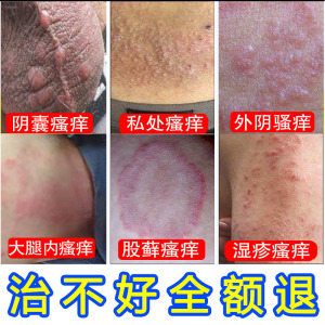 阴囊潮湿皮肤瘙痒去男女外阴私处大腿内侧屁眼阴茎龟头包皮止痒膏